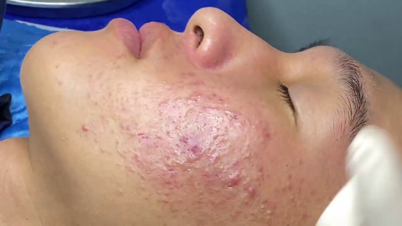 Inflammatory Acne Hematoma | Mụn Viêm Tụ Máu Dưới Da - SacDepSpa#290