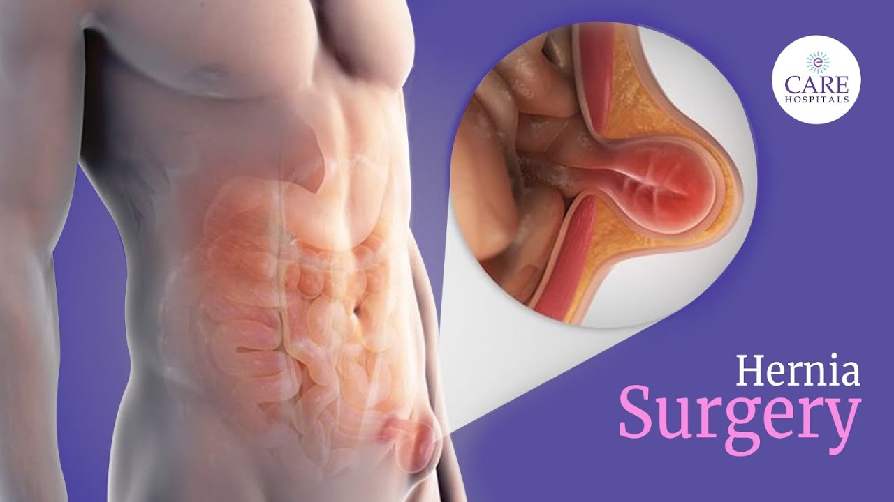 Laparoscopic Inguinal Hernia Repair | Hernia Surgery | CARE Hospitals