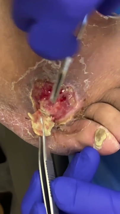 Debriding Diabetic Ulcers: A Critical Step in Wound Healing