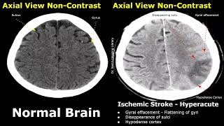 CT Scan Brain Normal Vs Ischemic Stroke Images | Non-Contrast Hyperacute/Acute/Chronic Infarction