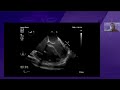 3. Echocardiographic differences in acute and chronic lung failure. Dr. Selene Martinez