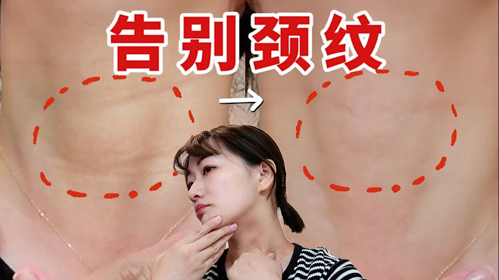 How to get rid of Neck Lines and Wrinkles without surgery