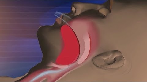 How sleep apnea affects your weight