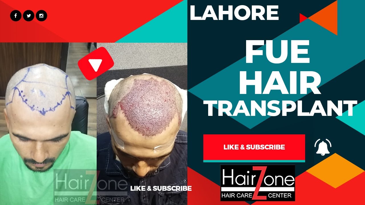 FUE Hair Transplant Lahore YouTube