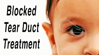 Blocked Tear Duct Surgical Correction Animation