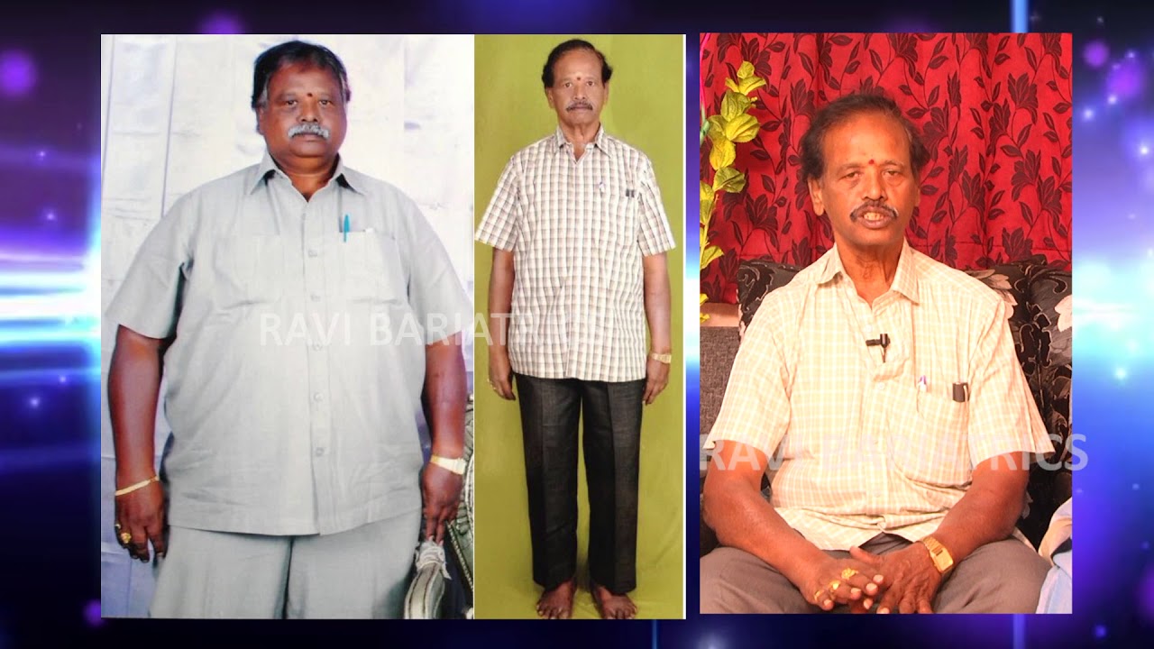 best bariatric surgery results by Dr Ravikanth kongara Hyderabad Vijayawada