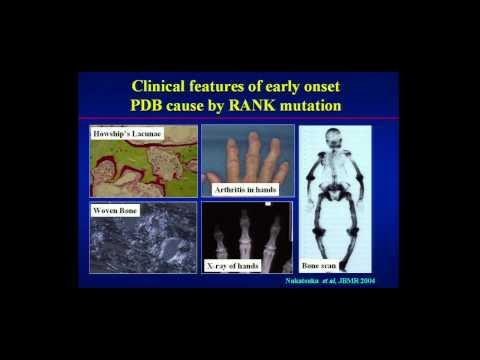 Prof. Stuart Ralston - Solving the Mysteries of Paget&rsquo;s Disease