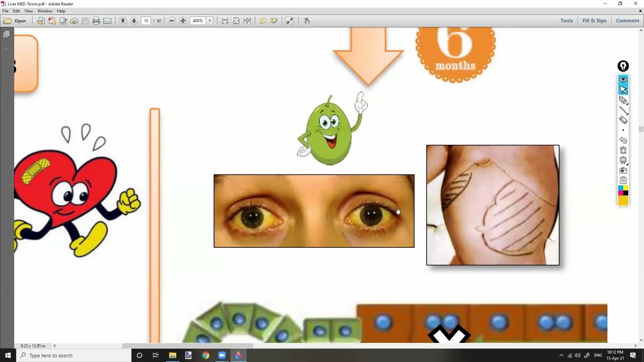 1-Jaundice &  Ascites شرح باطنة دكتور سويلم