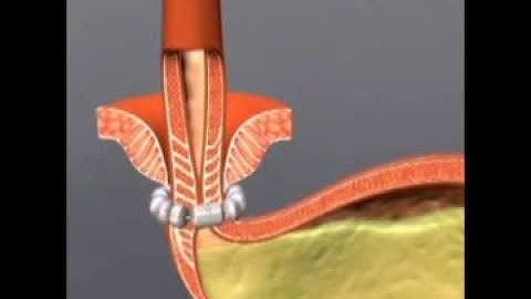 Using LINX to Treat GERD at Stony Brook Medicine