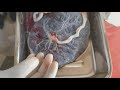 Placental examination umbilical cord, attachment of placenta#examination #procedure#nursing,gnm,bsc