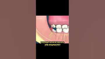 Что будет если не удалять зубы мудрости?🦷 #стоматолог #стоматология #зубмудрости