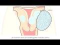 Fibroid  what is a fibroid and how can it be treated