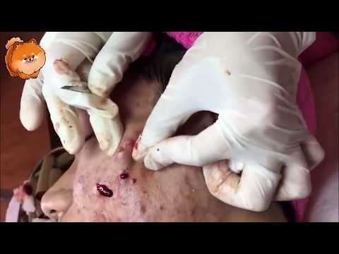 Severe Cystic Acne And Pimples Extraction On Face  Video