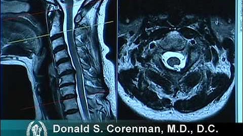 How to Read a MRI of Cervical Stenosis with Spinal Cord Injury | Spine Surgeon in Colorado
