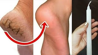 मोमबत्ती का ये तरीका 1 दिन में फटी एड़ियां से छुटकारा पाये !Cracked Heels Remedy,Crack Hel Treatment