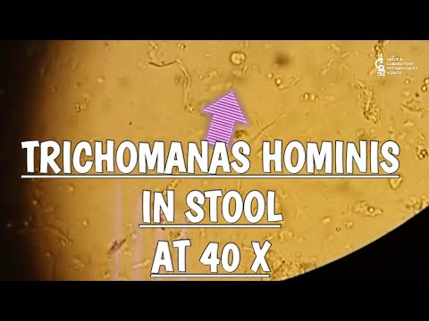 Trichomonas Hominis in stool microscopy at 40X.