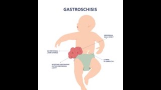 Download lagu MRCOG PART 3 I Counselling about Gastroschisis