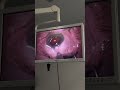 Zeiss AT-Lisa Trifocal injection during cataract op at Phoenix Hosp Chelmsford. #cataractsurgery