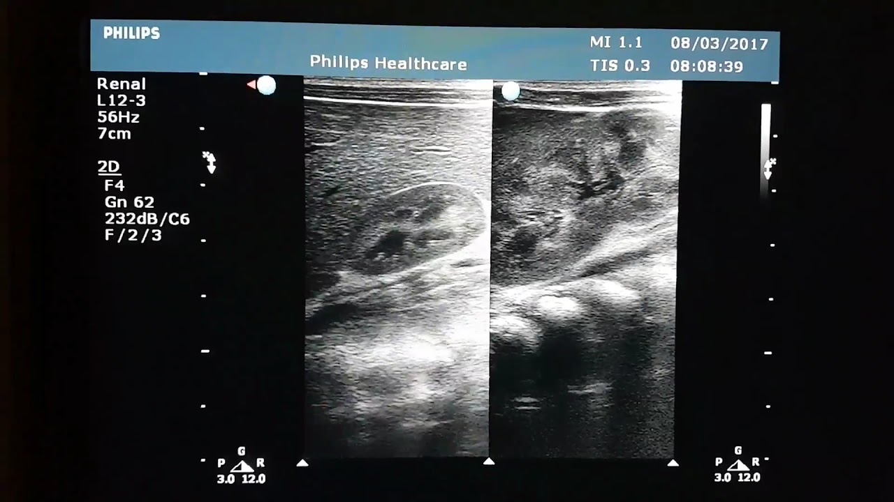 Neonatal Sonography Right Hypoplastic Kidney Youtube