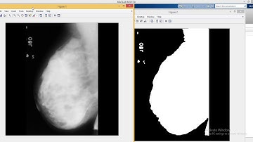 Breast Cancer Detection in Matlab
