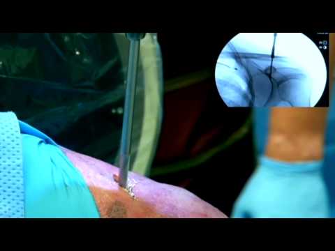 AC separation percutaneous(minimally invasive) surgery