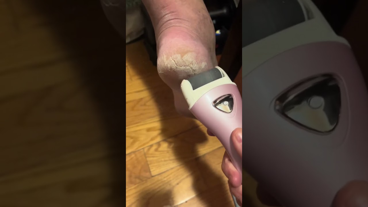 Effortless Callus Removal with This Amazing Product 