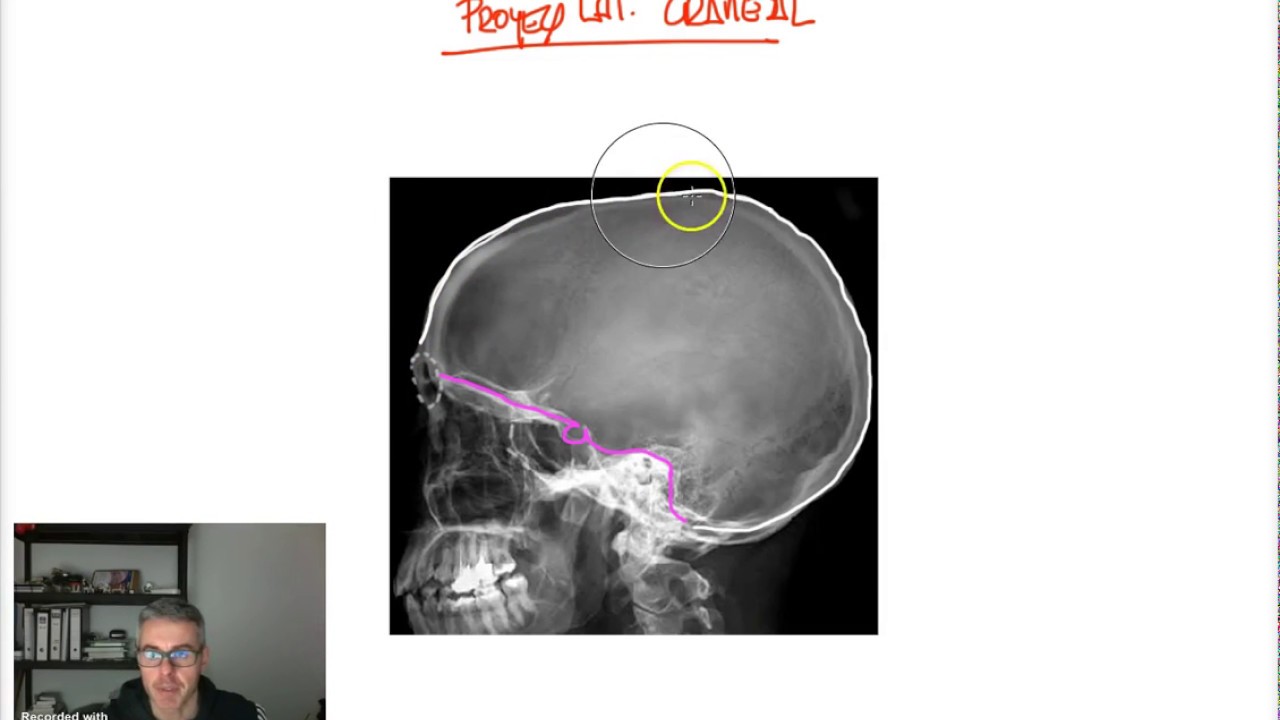 ESTUDIO RX 1 - Proyeccion lat 1