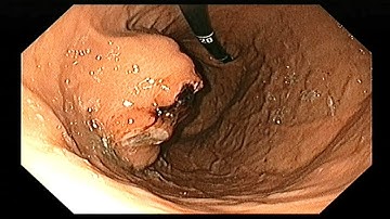Gastric tumour (GIST)