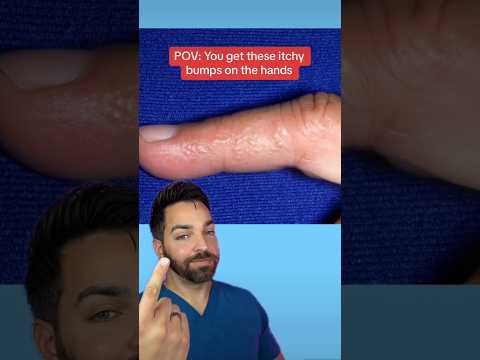 Video: Este dermatita veziculoasă a mâinii contagioasă?