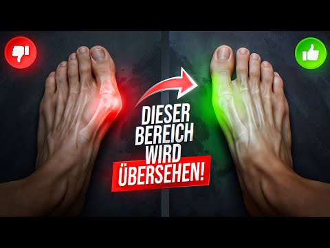 3 Übungen gegen Hallux Valgus | Ursache & Lösung (Ohne OP)