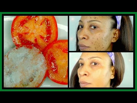 HOW TO GET RID OF DARK SPOTS ON FACE + BODY, CLEAR  ACNE SCARS IN  DAYS |Khichi Beauty