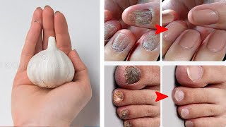 Garlic To Heal Your Toenail Fungus At Home Overnight