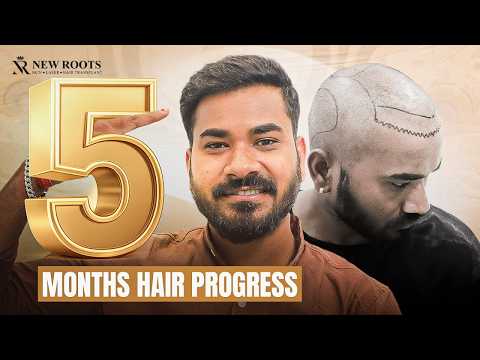 The Glow-Up After Hair Transplant Is Crazy 😮 | Hair Transplant in Nagpur | New Roots