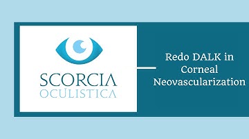 Redo DALK in Corneal Neovascularization