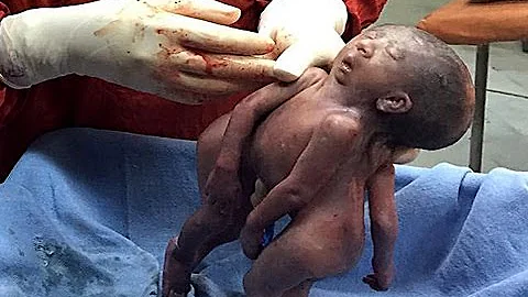 The Siamese twins who shared a FACE: pictures show babies born with just one head between them