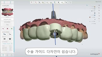 3Shape 임플란트 스튜디오-임플란트 케이스를 3Shape 디지털 방식으로- 3Shape Implant Studio-Implantology the digital way
