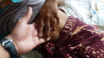 Pseudohypoparathyroidism type 1a or Albright