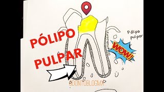 Pulpa hiperemia