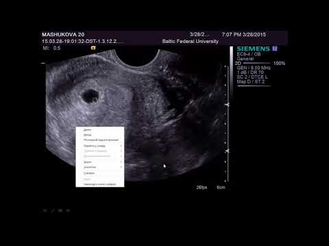 Ультразвуковая диагностика беременности. I триместр
