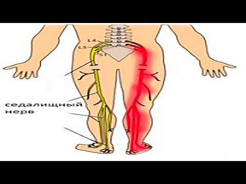 Как в домашних условиях вылечить седалищный нерв