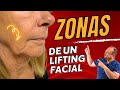 Zonas Del Rostro Para el LIFTING Facial 💕  Tercio Inferior, Medio y Superior 🚨 Dr Alberto Calvo