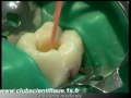 Endodontie mcanise le systme protaper principes et guide dutilisation