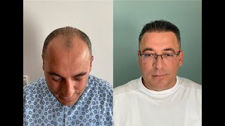 Kayseri Roza Saç Ekim Merkezi Kazım Selvi