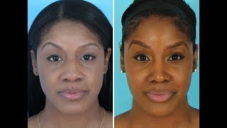 Ethnic Rhinoplasty: African American Rhinoplasty