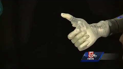 Latest technology in arm prosthetics give amputees a new chance at life