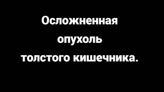 видео: Осложненная опухоль толстого кишечника картинка: Осложненная опухоль толстого кишечника