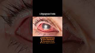 Anterior segment eye diseases | Eye disease | #shorts #hospital #optometry #doctor #ophthalmology