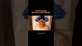 Real ECT Footage. How Depression Is Treated Safely #ect #shortsfeed #science