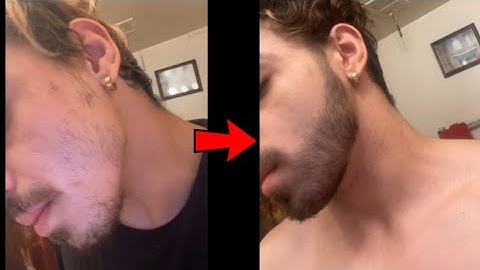INSANE MINOXIDIL BEARD JOURNEY 8 MONTH TRANSFORMATION