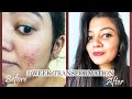 How to Remove Pimples Naturally at home in 2 weeks | Clear and Spotless Skin (in Hindi) #homeremedy